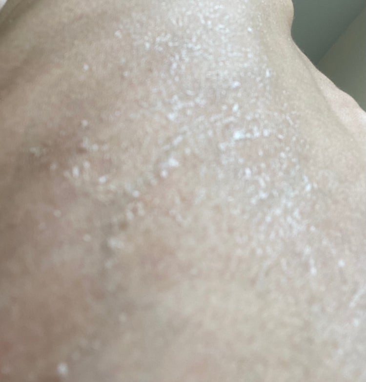 피부에 하얀껍질? 각질? : 지식iN