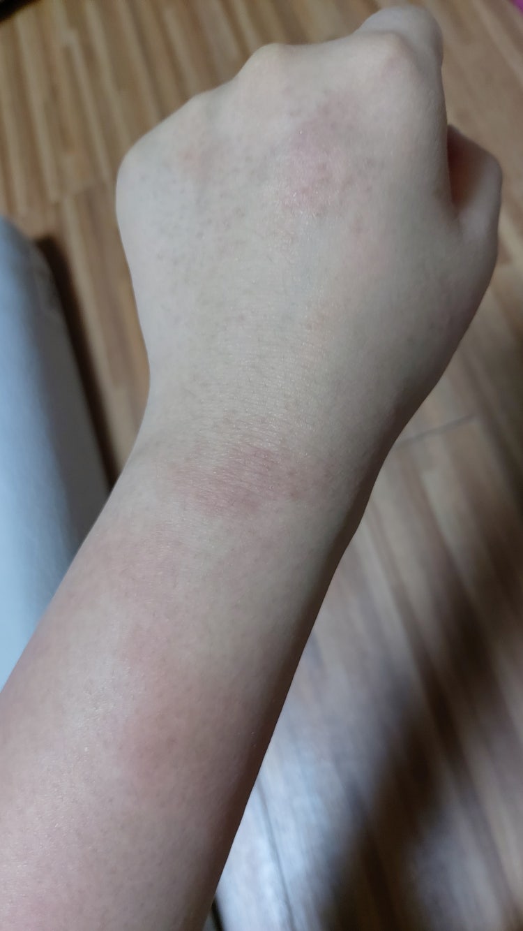 라텍스 알레르기일까요? : 지식iN