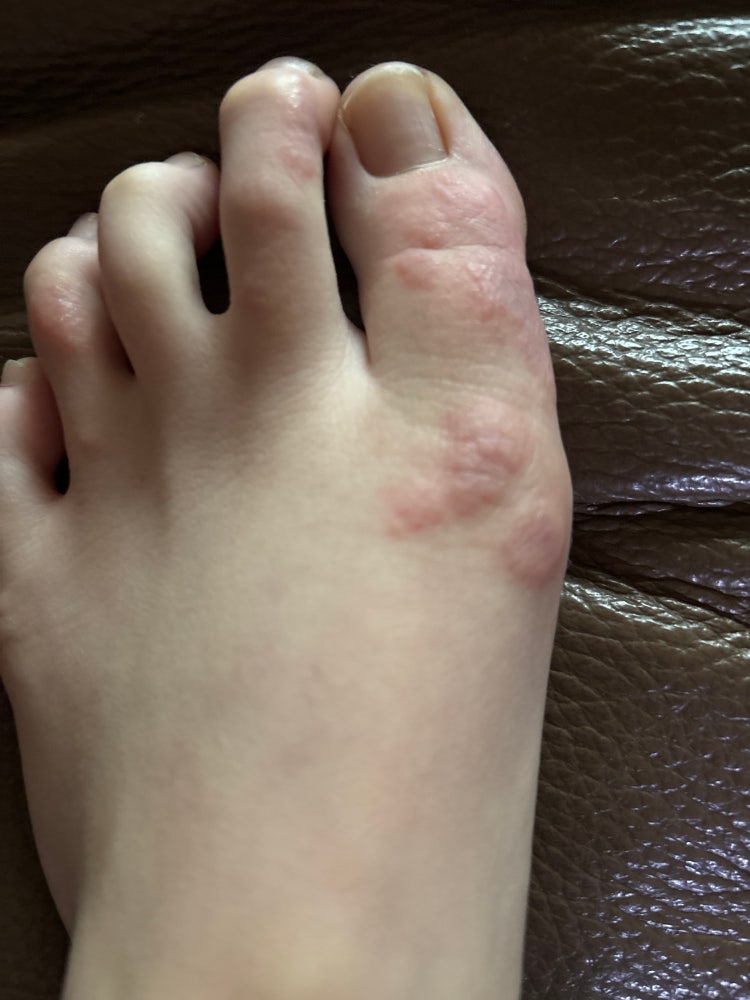 발 수포? 한포진? : 지식iN
