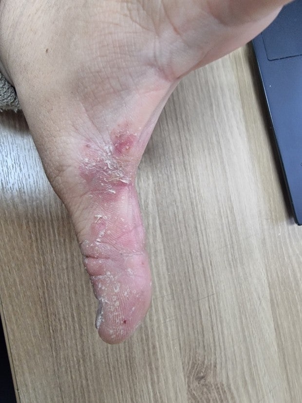 손가락 무좀? 습진? 질문드립니다. : 지식iN