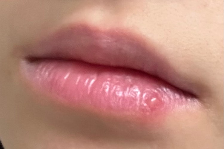 입술 물집 : 지식iN