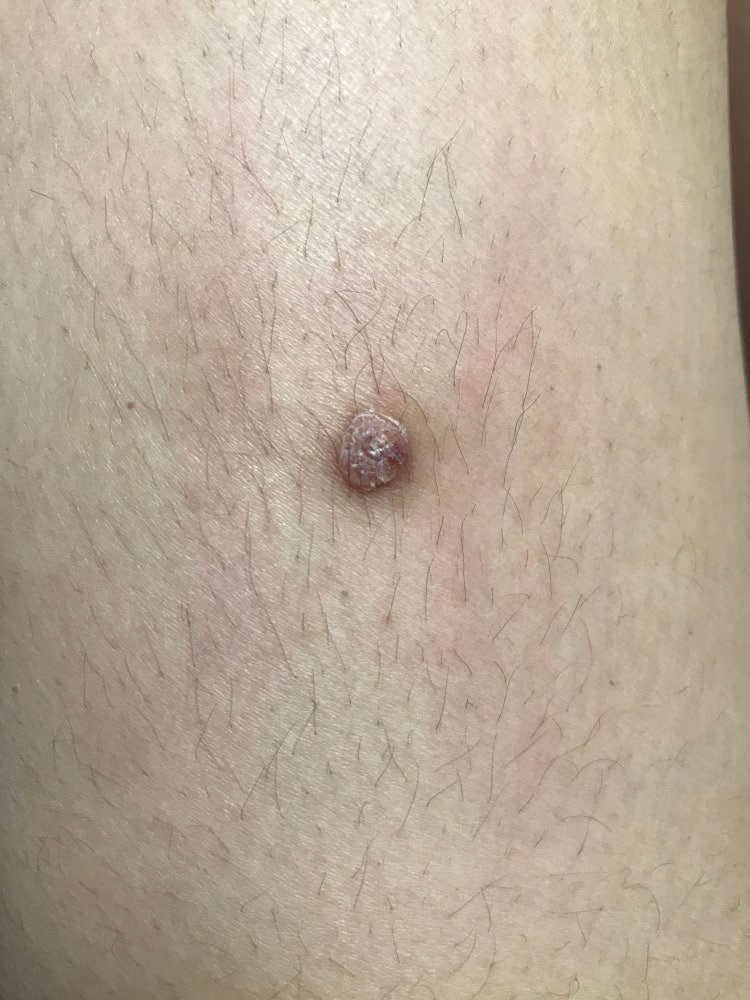 피부섬유종 : 지식iN