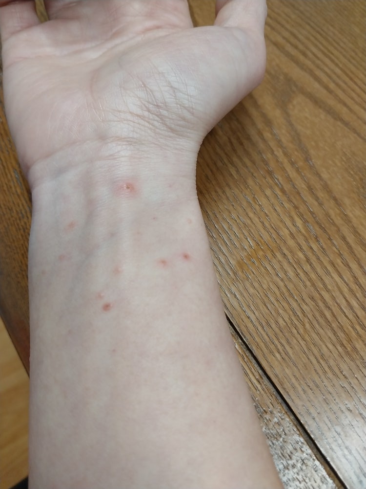 피부알러지 : 지식iN
