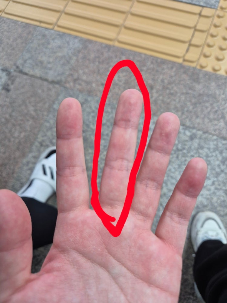 중지 손가락 통증 : 지식iN