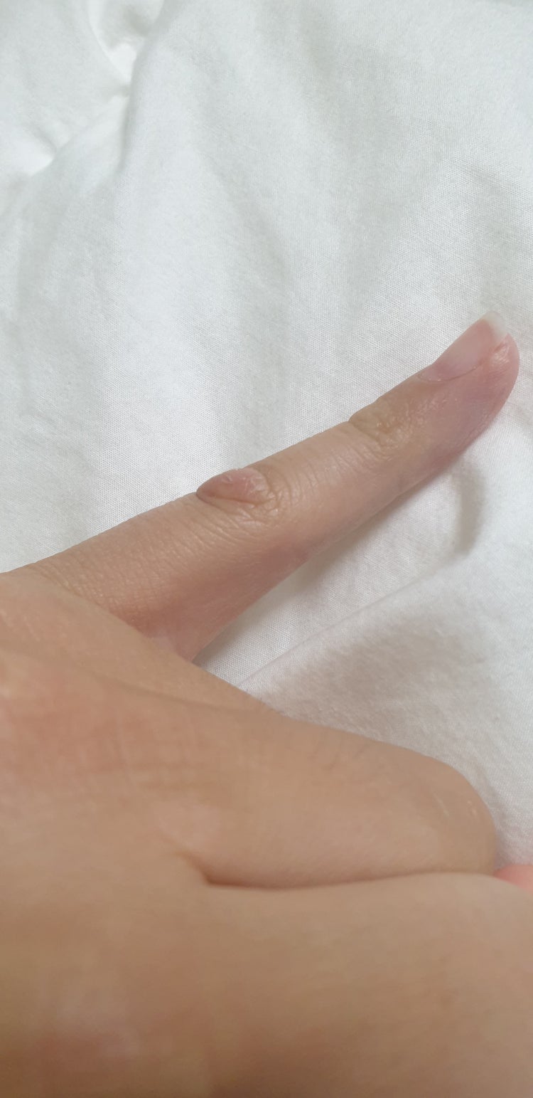 약지 손가락 부음 : 지식iN