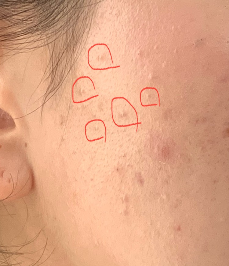 이거 좁쌀여드름인가요?? : 지식iN