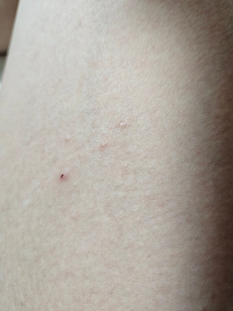양쪽 사타구니 허벅지 위쪽에 이런 게 생겼어요 : 지식iN