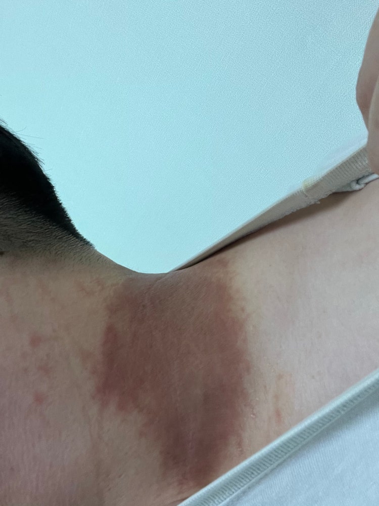 피부 건조증 아토피 질문입니다 지식iN
