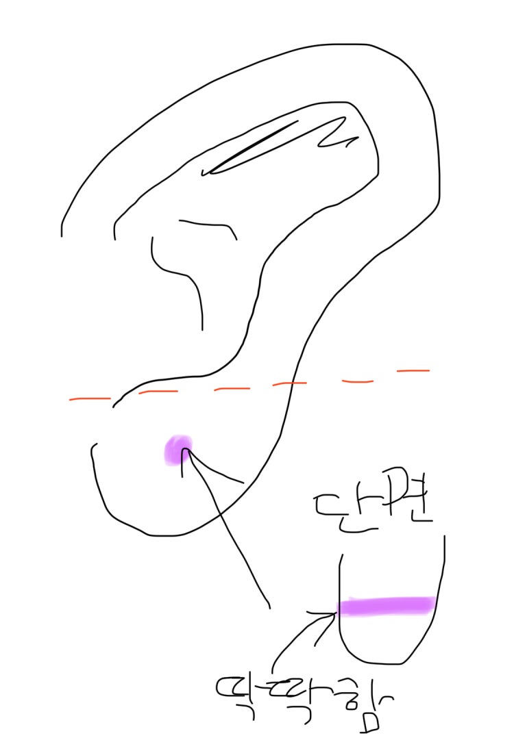 귀 막힌 곳 딱딱함 : 지식iN