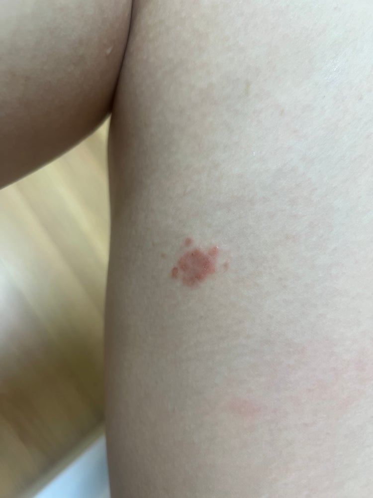 피부 습진(?), 두드러기 : 지식iN