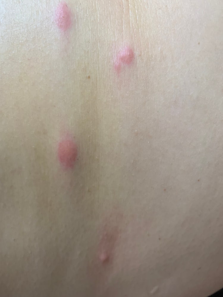 피부 습진? 두드러기 : 지식iN