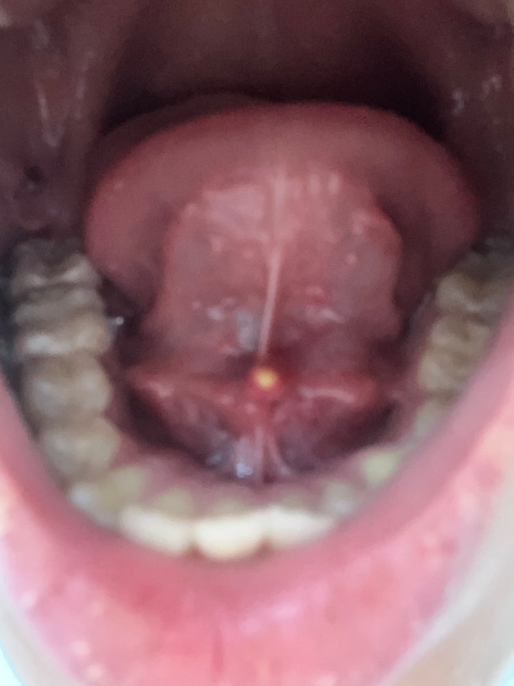 혀밑에 뭐가 생겼는데 뭔가요? : 지식iN