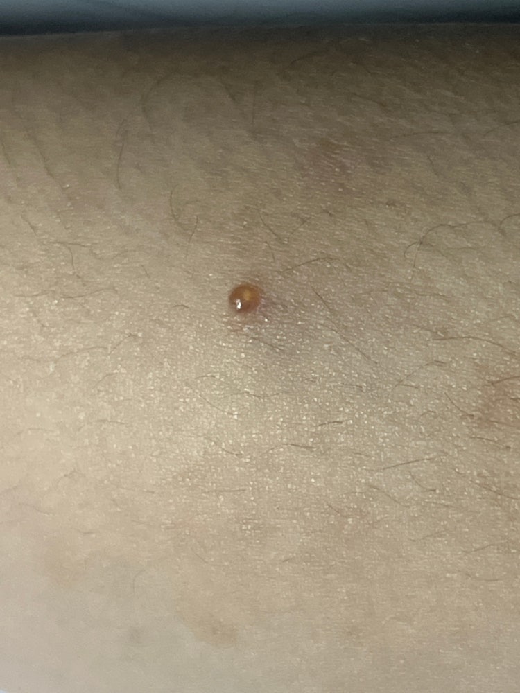 팔에 물집? 멍울? : 지식iN