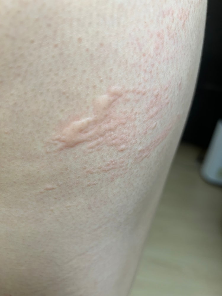 피부 알러지 두드러기 : 지식iN
