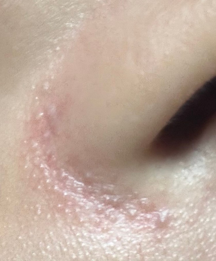 코 옆에 피지덩어리..? 이거 어떻게 없에요?ㅜㅠㅜㅜ : 지식iN
