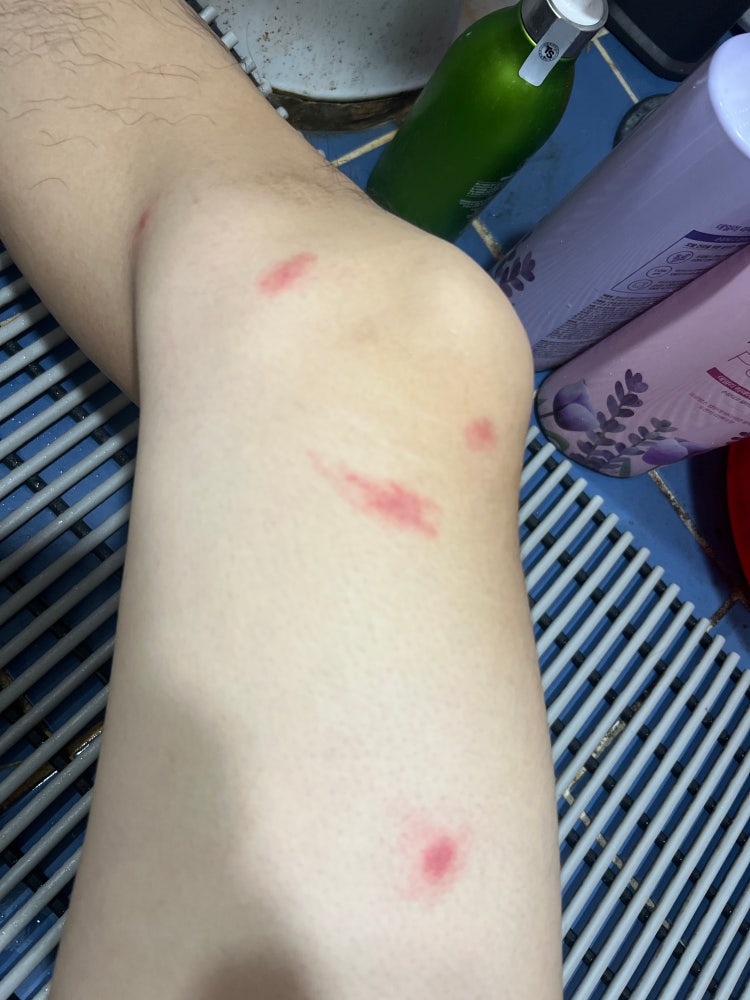 벌레물림 어떤 벌레인지 : 네이버 지식iN