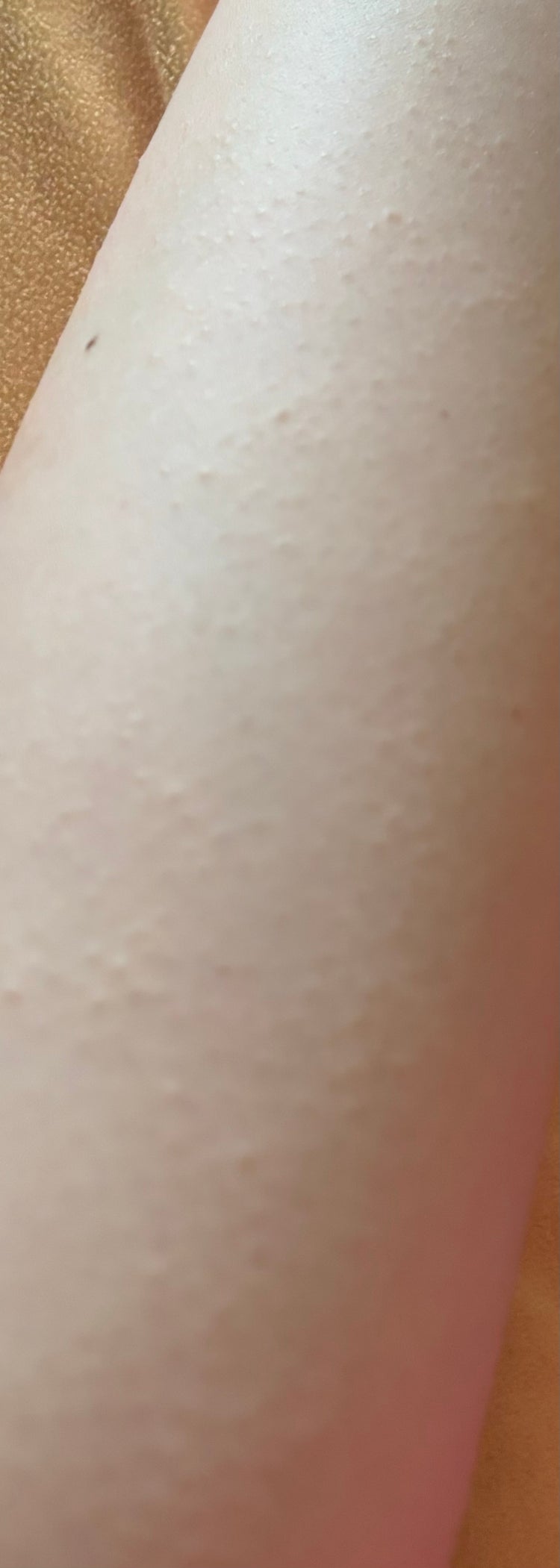 팔 모공각화증 어떻게 없애나요? : 지식iN