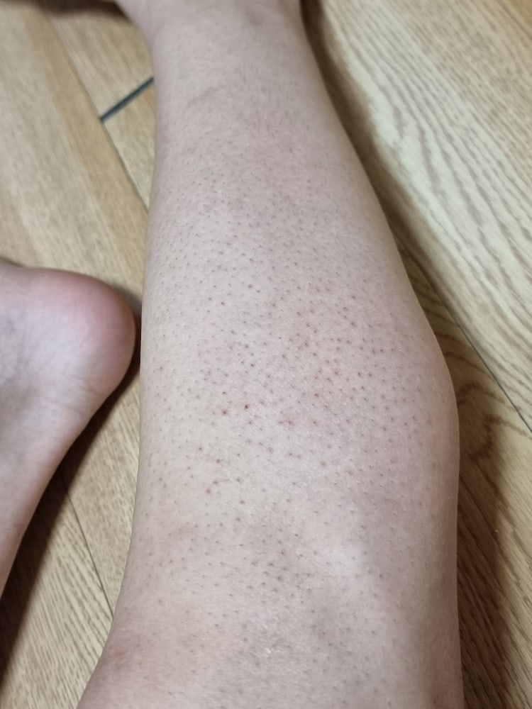 다리털 제모 후 가려움 : 지식iN