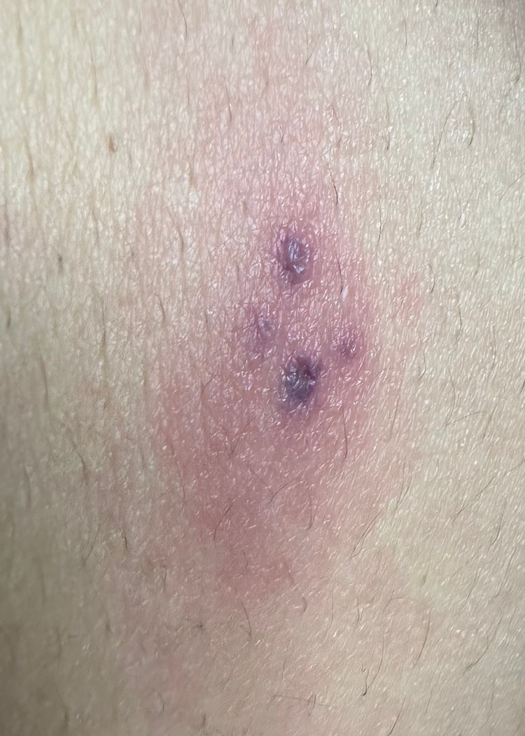 벌레물림? 피부뾰루지? 종기? : 지식iN