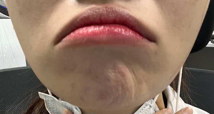 자갈턱보톡스 비대칭 봐주세요 : 지식iN