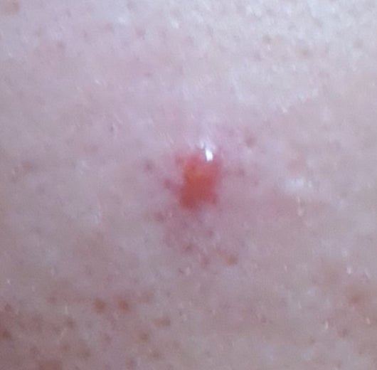 얼굴피부인데 물집? 뭔가요?(사진첨부) : 지식iN