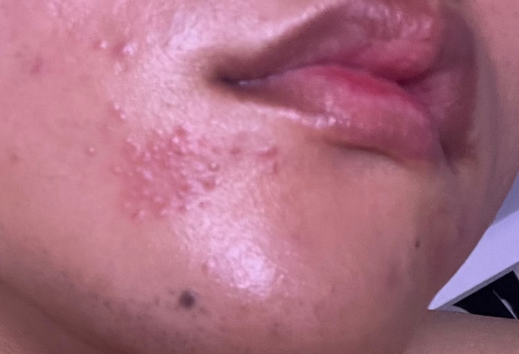 입 주변 수포? : 지식iN