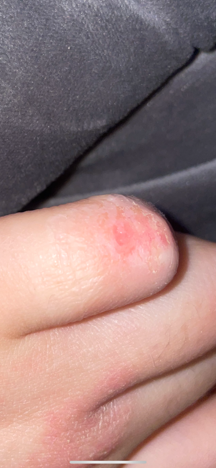 습진 어떻게 치료하나여 : 지식iN