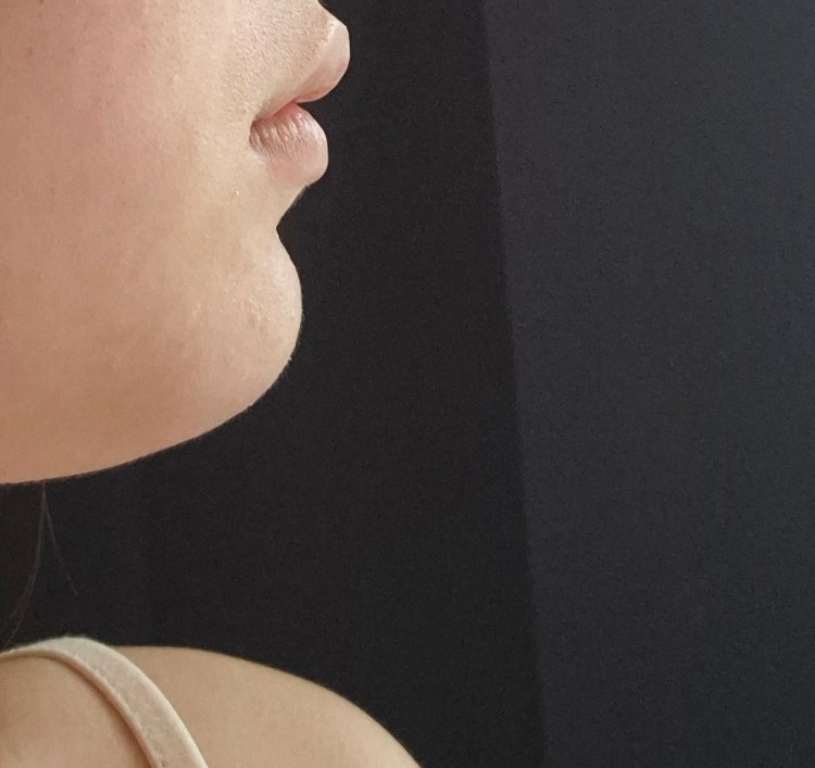 입술 아래 볼록한 턱살 지방을 뺄 수 있나요? : 지식iN