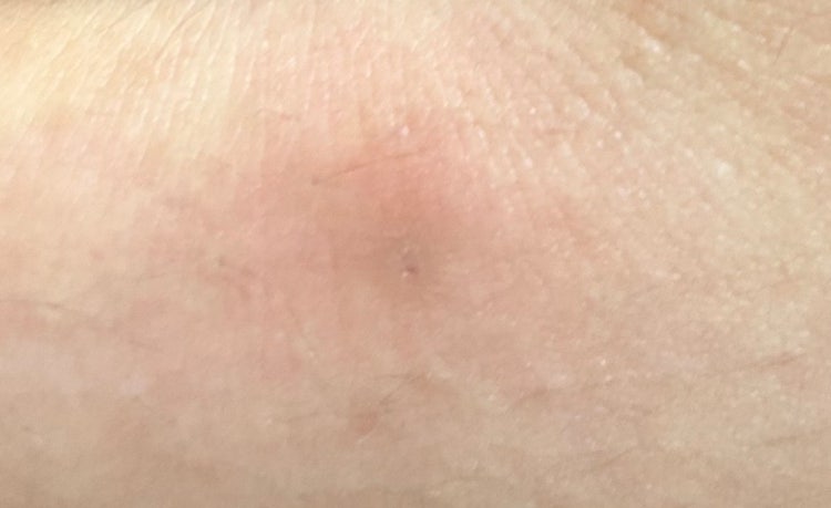 피부 멍울 아픔 : 지식iN