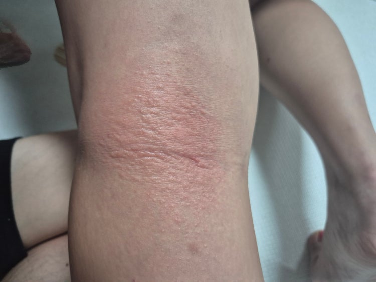 오금 가려움 뭘까요?? : 지식iN