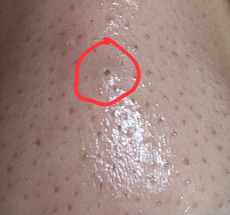 코에 표피낭종 : 지식iN