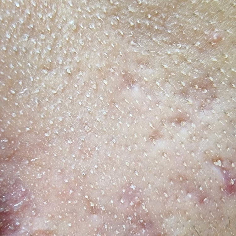 피부 각질? : 지식iN