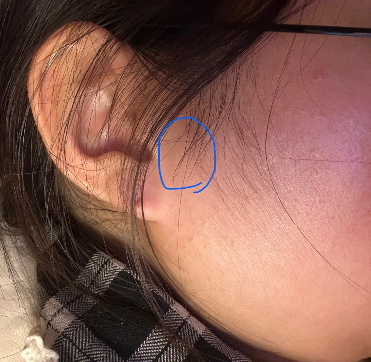 갑자기 귀 앞,턱 멍울 잡히고 만지면 아파요. : 지식iN