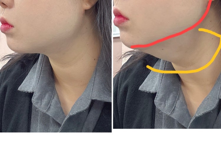 턱 밑 근육 뭔가요?? : 지식iN