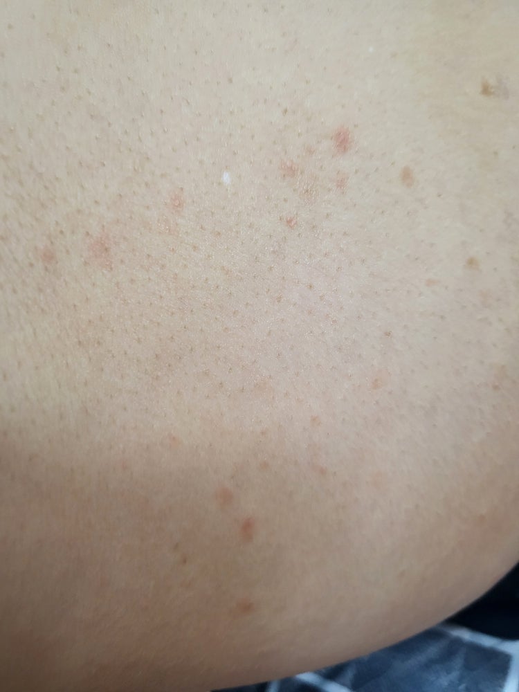 피부 발진 : 지식iN