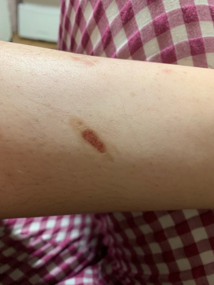 아토피 상처 부위에 화상 상처 : 지식iN