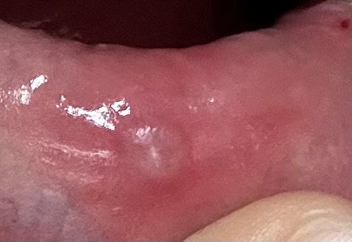 입술 안쪽에 생긴 멍울? 수포? 물집? : 지식iN