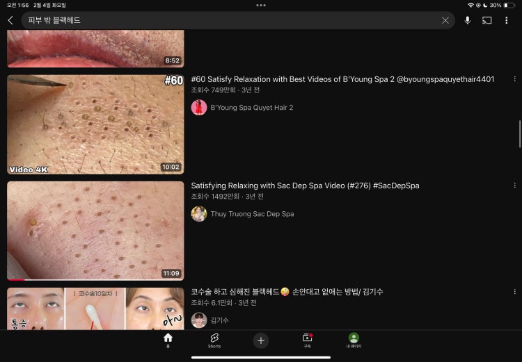 피지 종류 딱딱한 피지 피부 밖 피지 : 지식iN