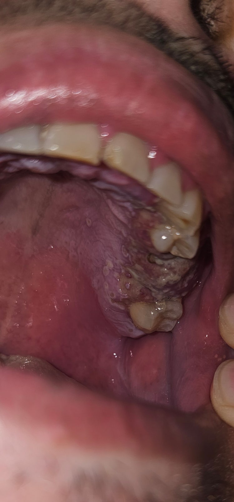 잇몸에 흰색병변이 생겼어요 : 지식iN