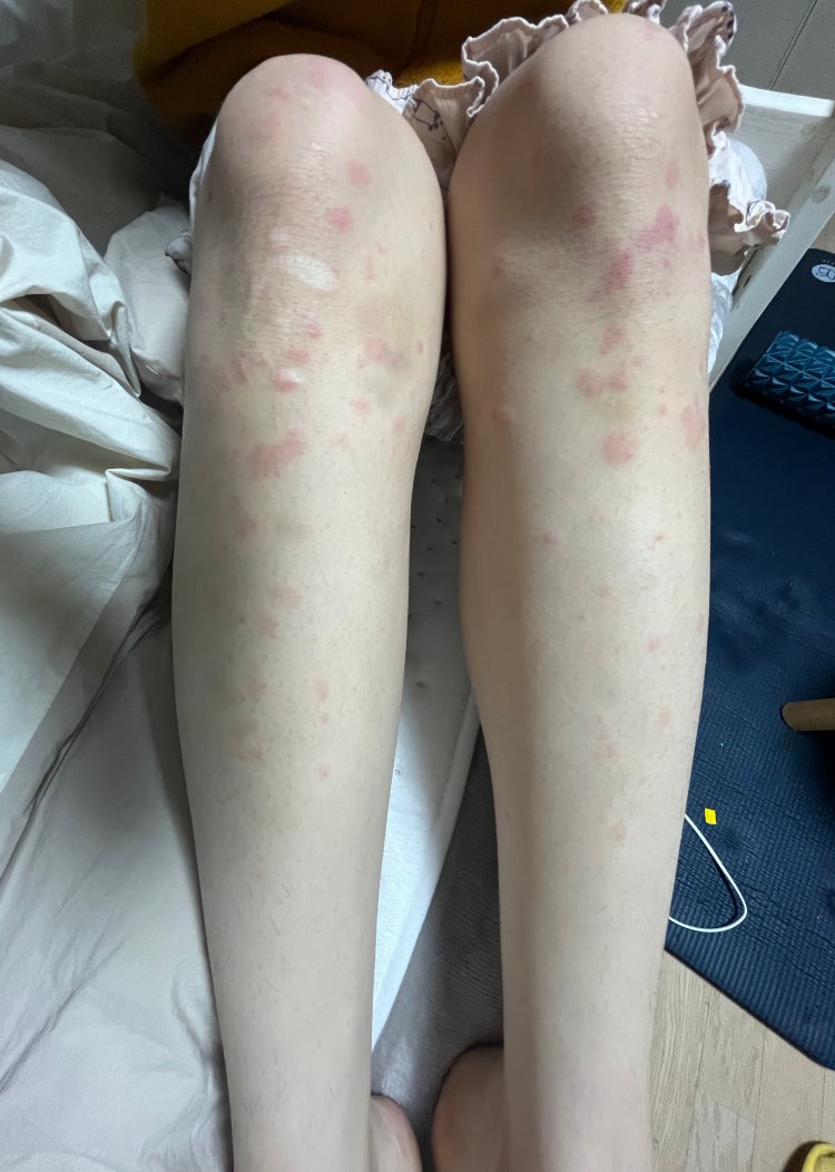 피부 발진 알러지 맞나요?? : 지식iN