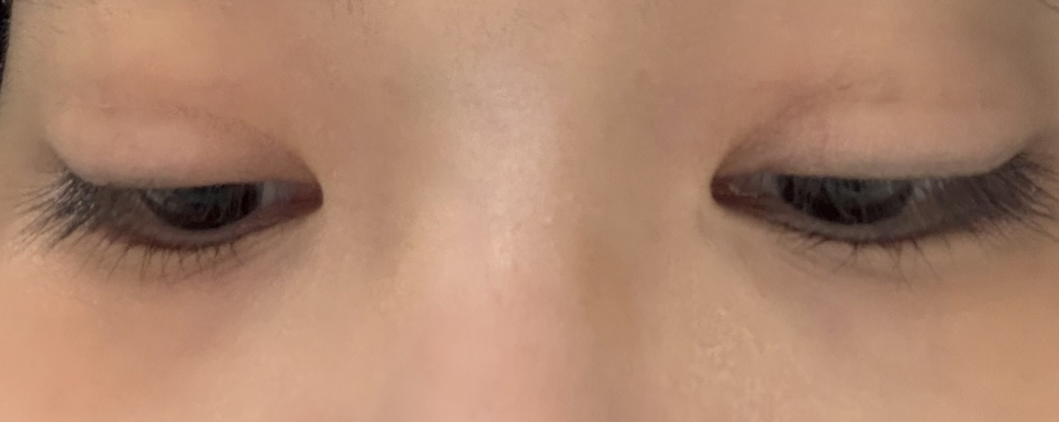 절개 쌍수 2년차 붓기 이게 맞나요? : 네이버 지식iN