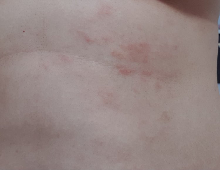 피부발진? 뭘까요 이게(사진) : 지식iN