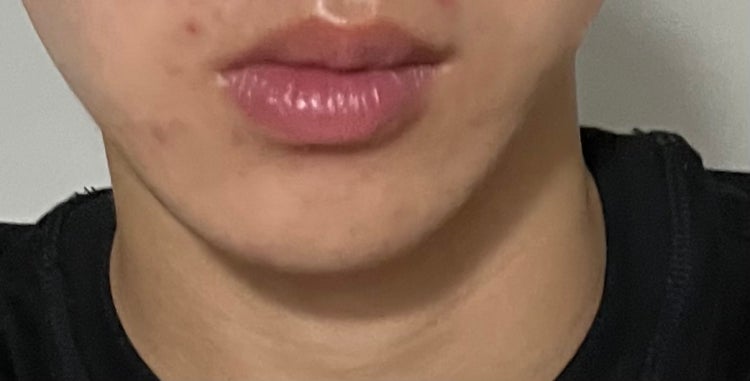 턱 비대칭… : 지식iN