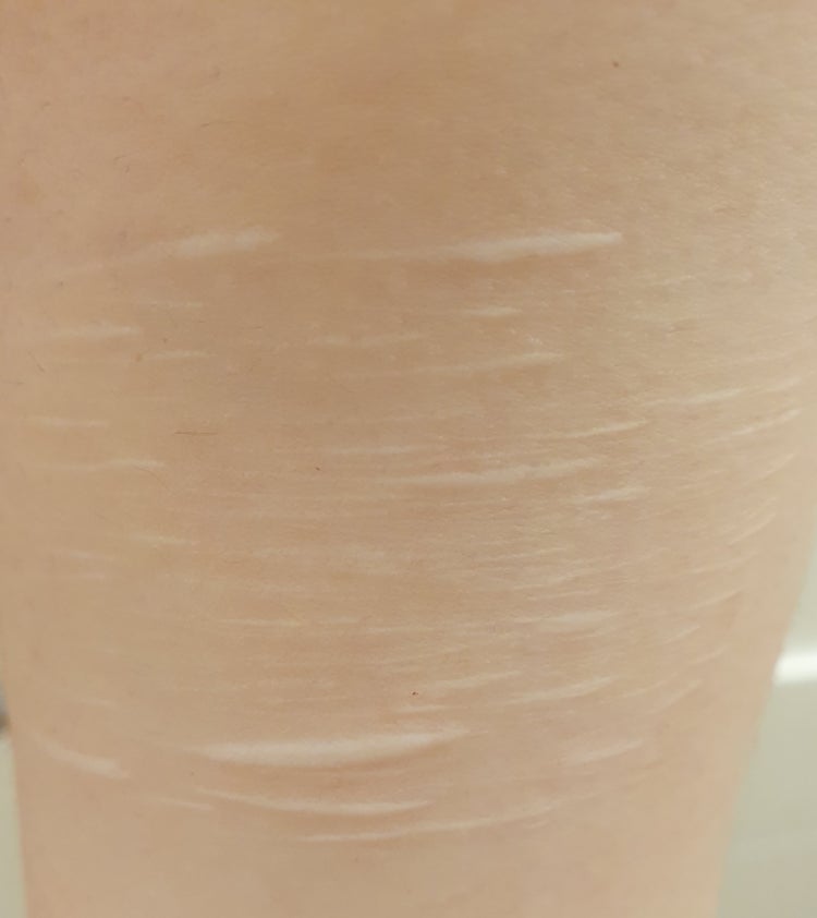 오래된 자상 흉터 없앨 수 있나요? (사진 첨부) : 지식iN