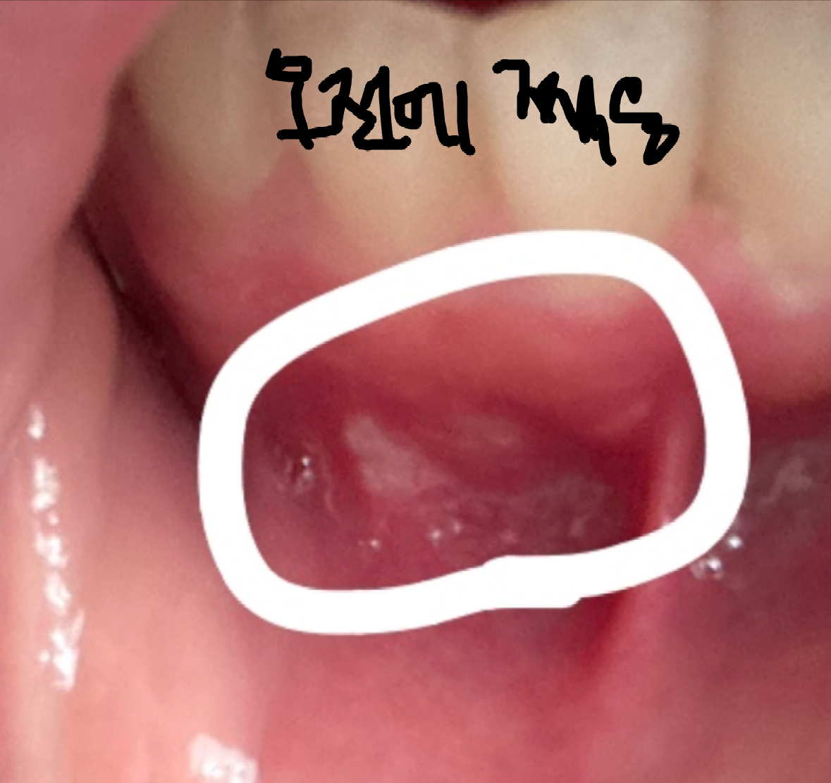 양치하다가 입병(구내염)이 생겼는데 빨리 낫는법은? : 네이버 지식iN
