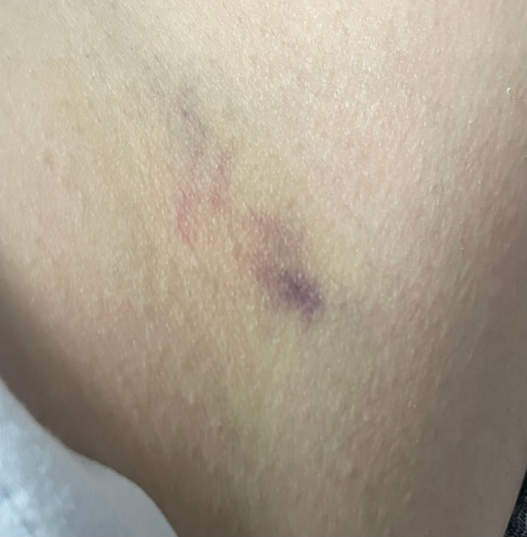오른쪽 골반에 피멍과 멍울 : 지식iN