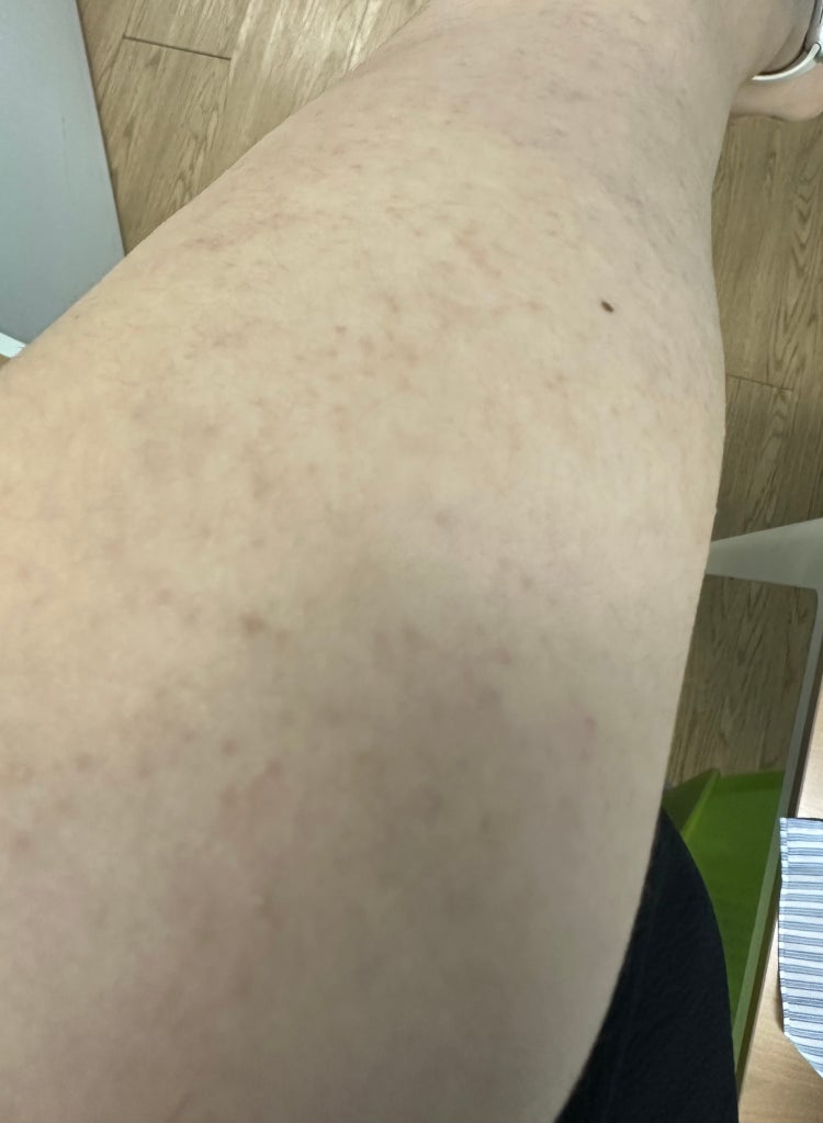 팔 모공각화증 : 네이버 지식iN