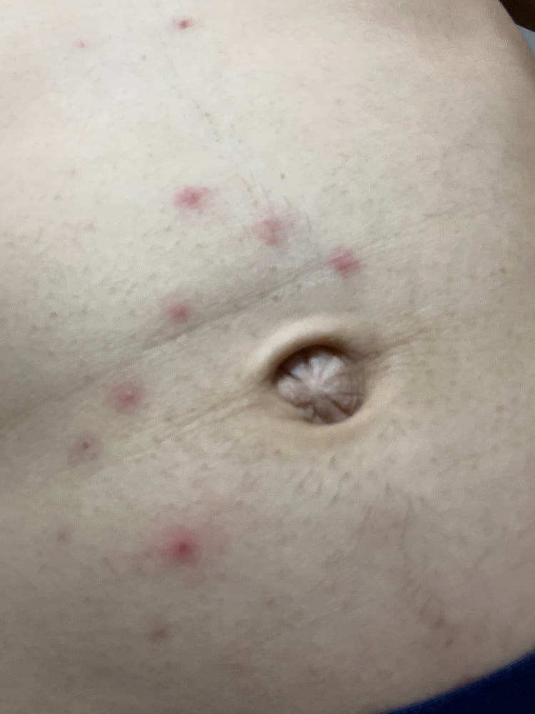 여드름?? 종기?? 몸에 붉은 점같은게 생깁니다 : 지식iN