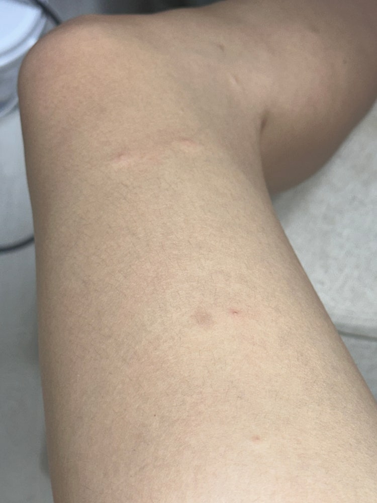 갑자기 팔다리에 생긴 물집? 대체 뭘까요..?? : 지식iN