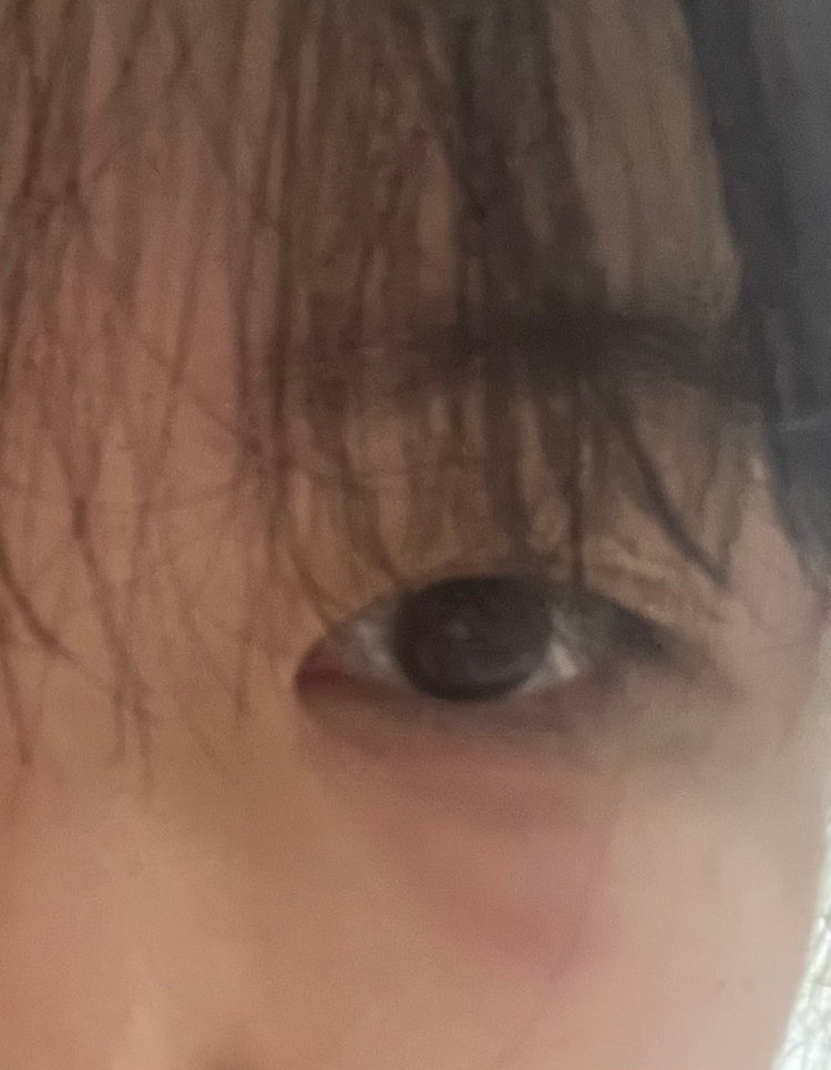 눈 밑 피부 붉어짐 : 지식iN